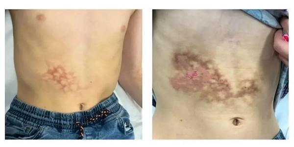 暗藏风险!英国男孩将笔记本放腹部使用 诱发火激红斑 暗藏风险!英国男孩将笔记本放腹部使用 诱发火激红斑